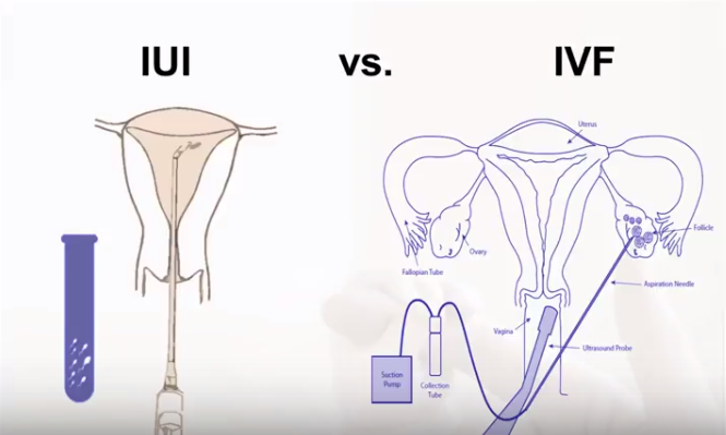 IVF vs IUI: Which fertility treatment is better for you? Doctors answer 4 IVF vs IUI